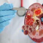 8 Tanda Ginjal Kotor yang Perlu Diwaspadai