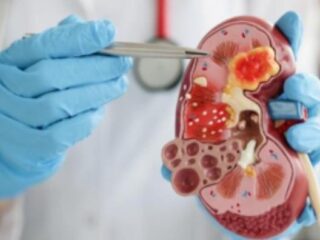 8 Tanda Ginjal Kotor yang Perlu Diwaspadai