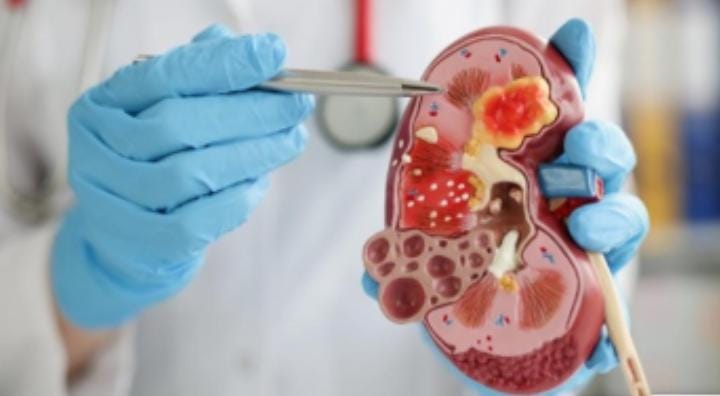 8 Tanda Ginjal Kotor yang Perlu Diwaspadai