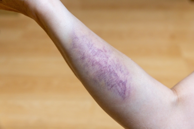 10 Obat Luka Dalam Paling Ampuh di Apotek, Cepat Kering & Cegah Infeksi