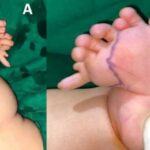 Bayi Aceh Alami Mirror Foot dan Polidaktili, Jalani Operasi Kaki Langka