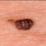 Tahi Lalat Hidup: Kenali Tanda Bahaya dan Cara Aman Menanganinya