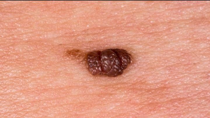 Tahi Lalat Hidup: Kenali Tanda Bahaya dan Cara Aman Menanganinya