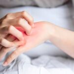 Kurap Menular? Ini Penjelasan, Cara Penularan, dan Pencegahannya