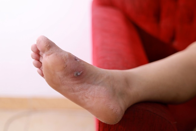 Waspada! Ini 8 Ciri-Ciri Kaki Diabetes yang Sering Tidak Disadari
