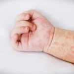 Waspada, Ini Gejala Awal Campak pada Anak