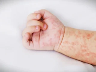 Waspada, Ini Gejala Awal Campak pada Anak