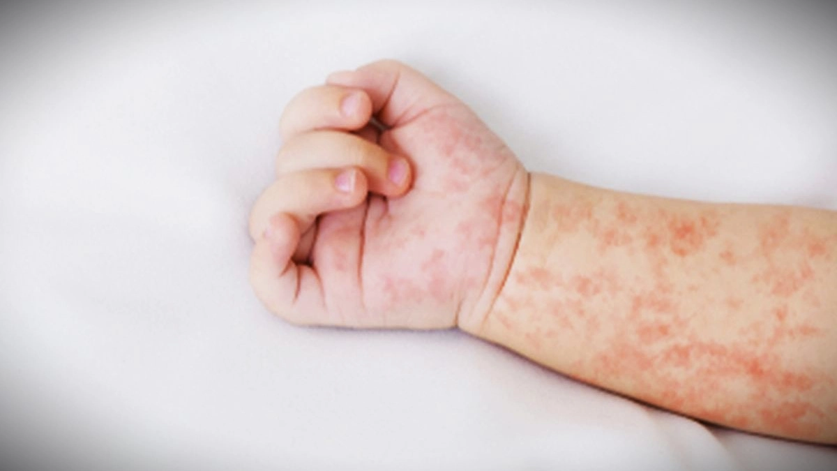 Waspada, Ini Gejala Awal Campak pada Anak