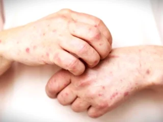 Campak Menular Dengan Cepat, Begini Cara Penyebarannya