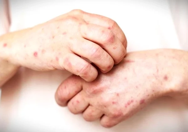 Campak Menular Dengan Cepat, Begini Cara Penyebarannya