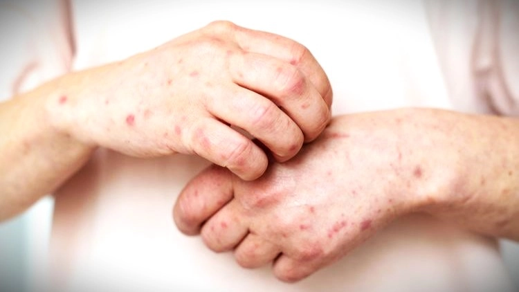 Campak Menular Dengan Cepat, Begini Cara Penyebarannya