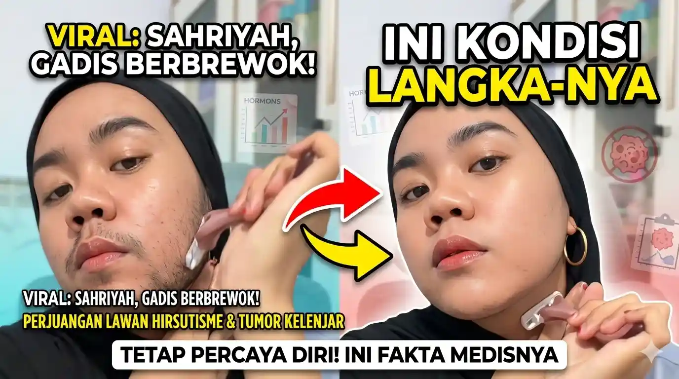 Perjuangan Sahriyah: Lawan Tumor Kelenjar di Balik Fenomena Brewok Unik pada Wajahnya